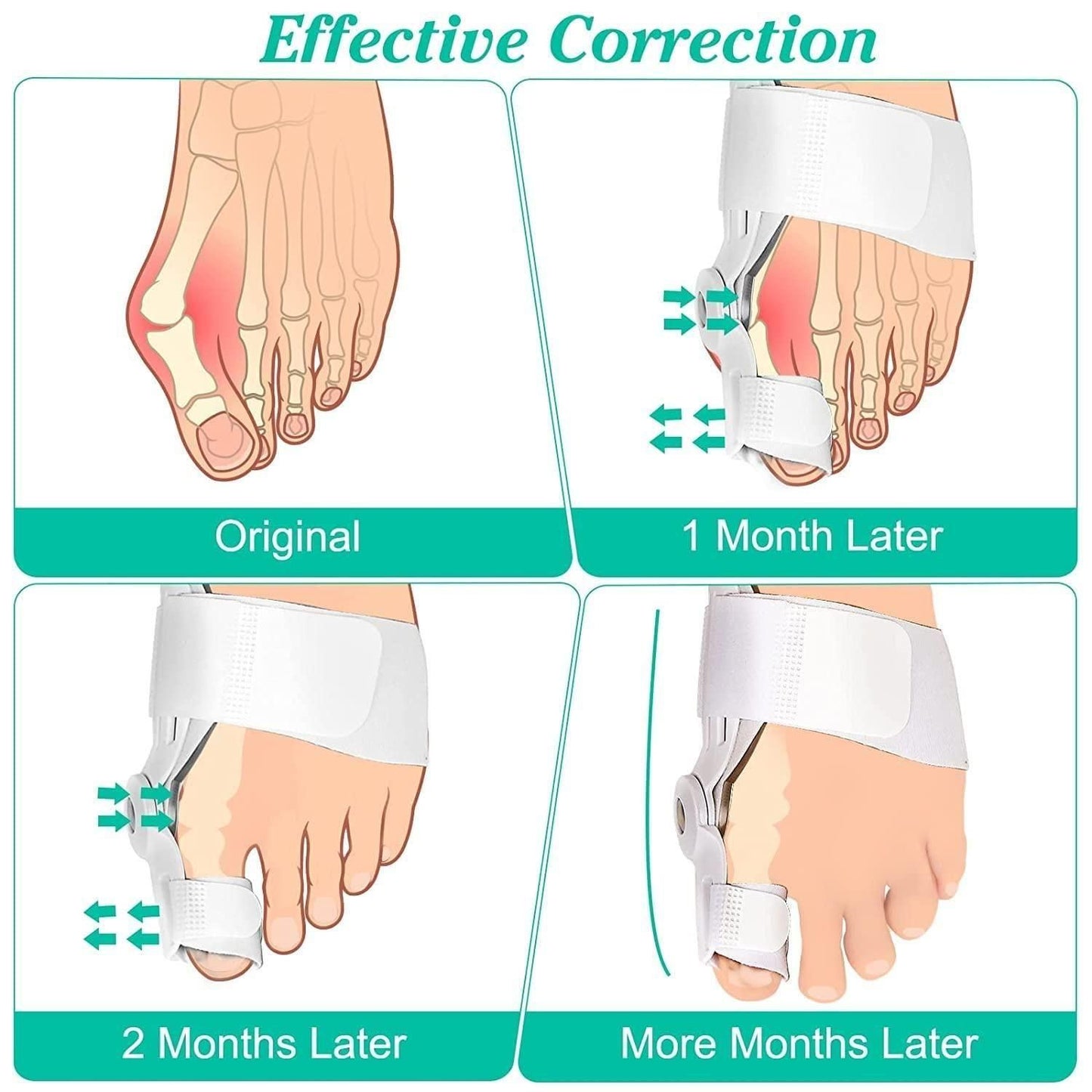 TOE CORRECTOR™ !!